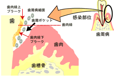 歯周病の図