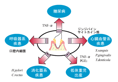 歯周病が全身に及ぼす影響イメージ